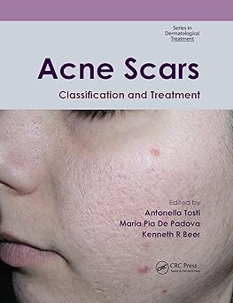 Acne Scars: Classification and Treatment