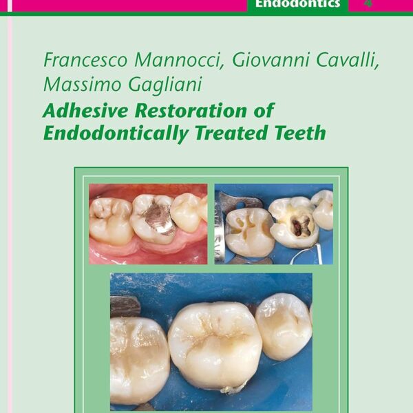 Adhesive Restoration of Endodontically Treated Teeth